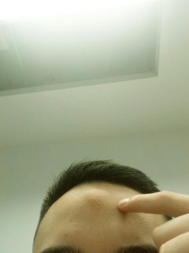 头顶上有个硬包